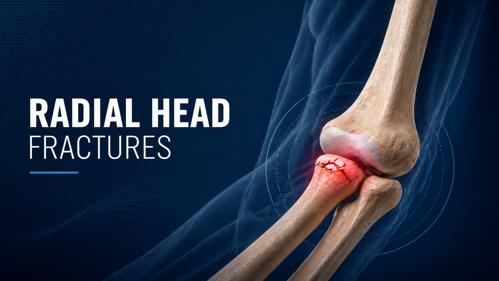 Radial Head Fractures